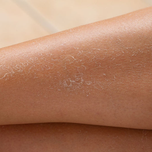 Close-up of extremely dry, flaky, and peeling skin on a person's leg, demonstrating symptoms of eczema or severe dehydration